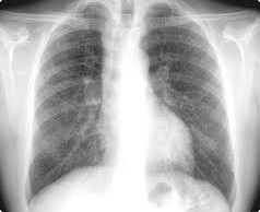 pulmonessilicosis